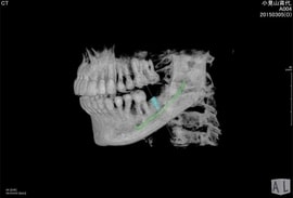 CT(3Dレントゲン画像)により、治療をより安全・確実に